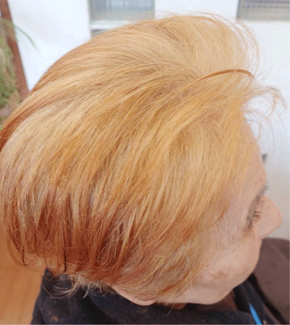 白髪染めをやめるための脱色